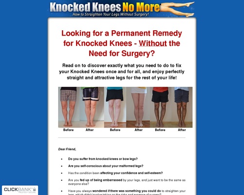Knocked Knees No More – How to Straighten Your Legs Without Surgery! – Health & Fitness